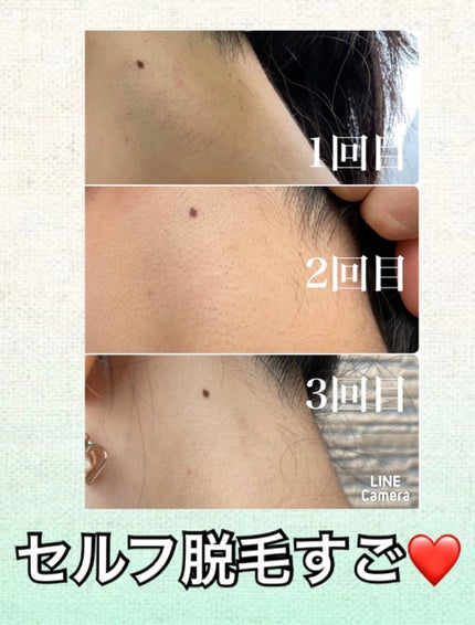 光美容器 光エステ <ボディ&フェイス用> ES-WH76/Panasonic/家庭用脱毛器を使ったクチコミ(1枚目)