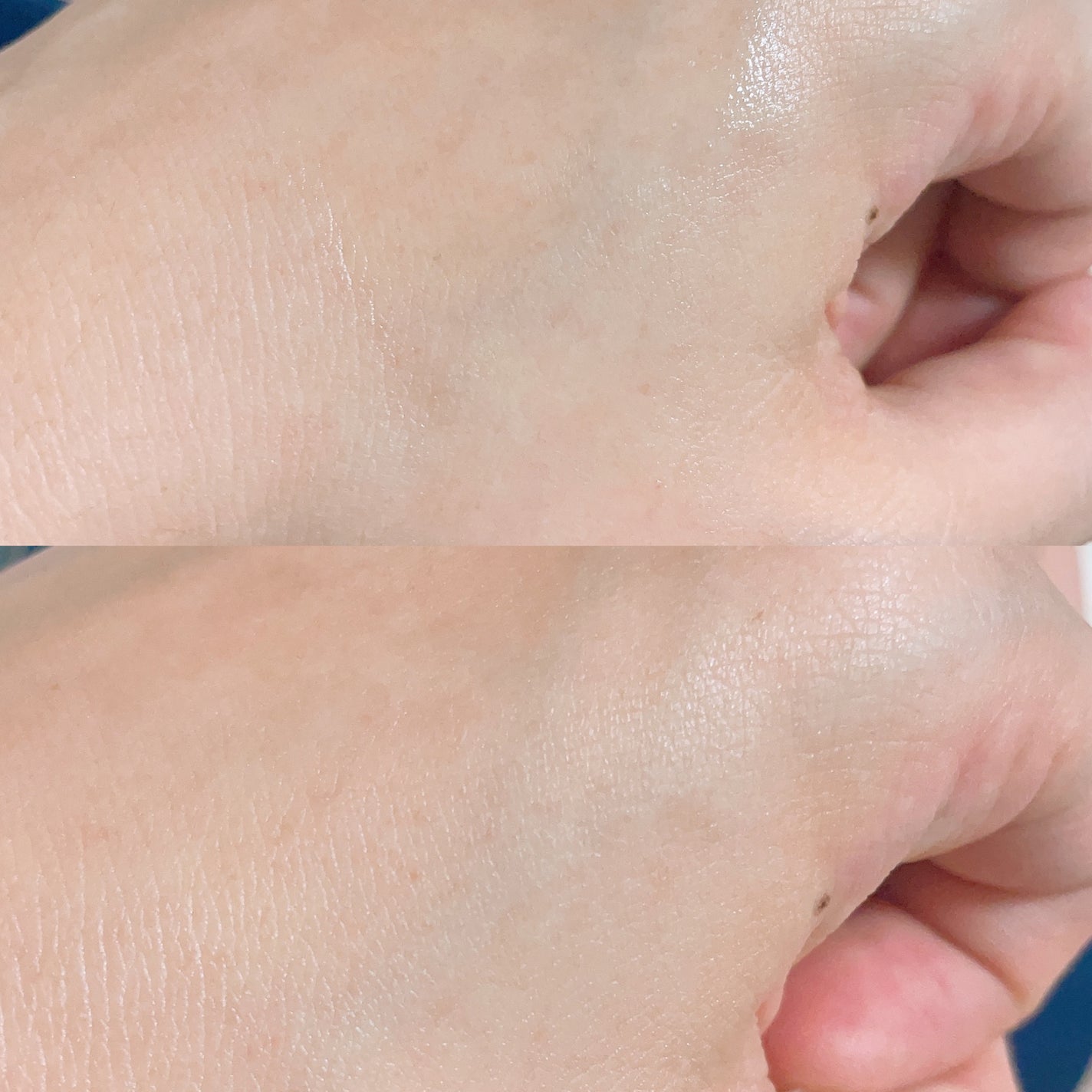 ミノン アミノモイスト 薬用アクネケア ローション/ミノン/化粧水を使ったクチコミ(3枚目)