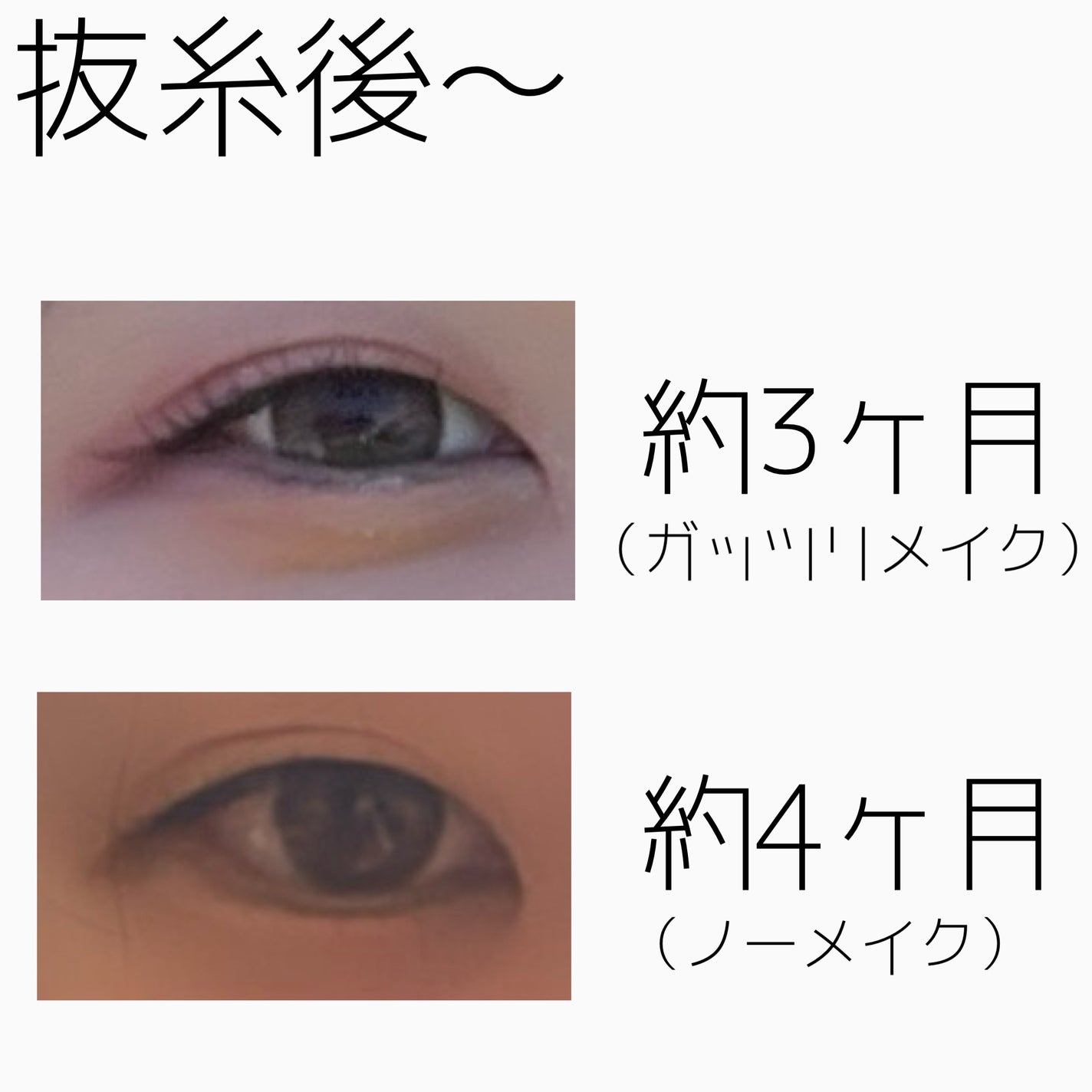 NANO@フォロバ! on LIPS 「二重整形ダウンタイム記録/抜糸してから半年が経ちました。約1ヶ..」(3枚目)