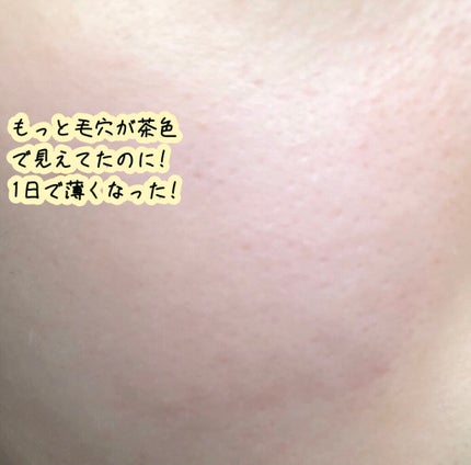 ビタペアC 集中美容液スペシャルセット/ネイチャーリパブリック/美容液を使ったクチコミ(3枚目)