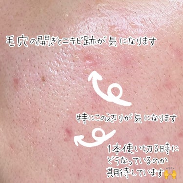 Kiehl's DS RTN リニューイング セラムのクチコミ「【もう最後はこれに頼る】※肌の写真を載せています⚠️

しまです🙌

長年毛穴の開きとニキビ跡.....」（3枚目）