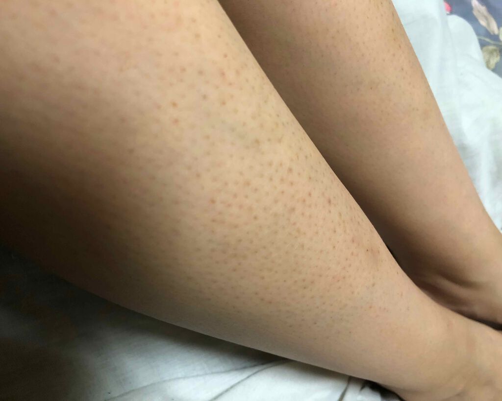 ケアノキュア（医薬品）/小林製薬/その他を使ったクチコミ（1枚目）