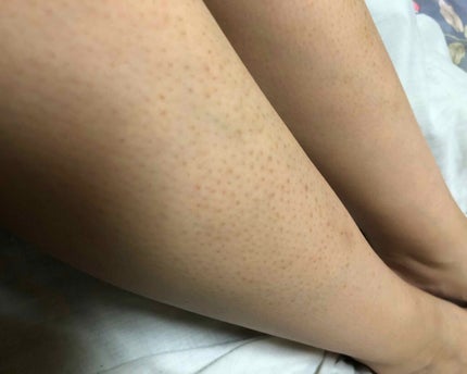 ケアノキュア(医薬品)/小林製薬/その他を使ったクチコミ(1枚目)