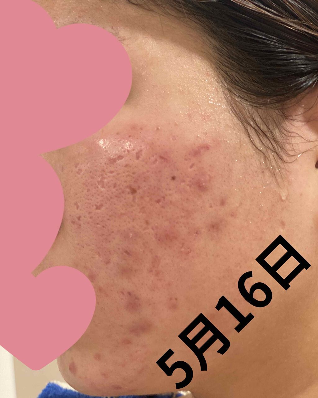 ! on LIPS 「皮膚科処方薬5日目見た目はそんなに変わらないですが、肌触りがツ..」(1枚目)