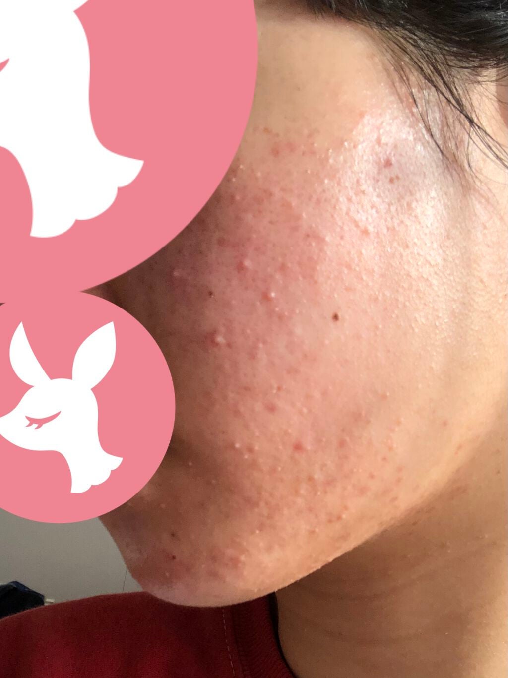 fresh_lips_b93 on LIPS 「皆様おはようございます2日目です若干ニキビが少なくなってきたか..」(2枚目)