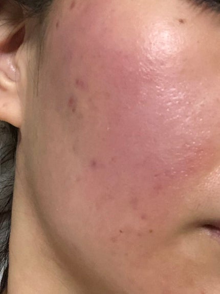 ちー on LIPS 「記録用に。4日目です!昨日より赤みが増した気がします。1日目よ..」(2枚目)
