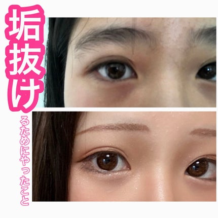 ペアアクネクリームW(医薬品)/ペア/その他を使ったクチコミ(1枚目)