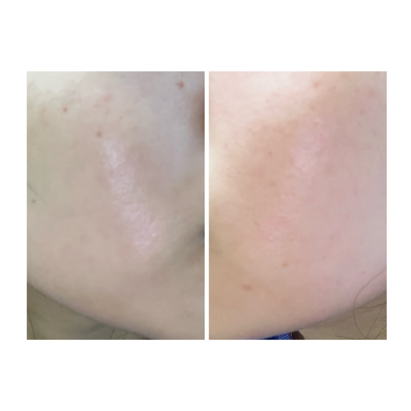 ぽむ on LIPS 「2023.9.13皮膚科に受診 エピデュオとヘパリン処方1枚目..」(5枚目)