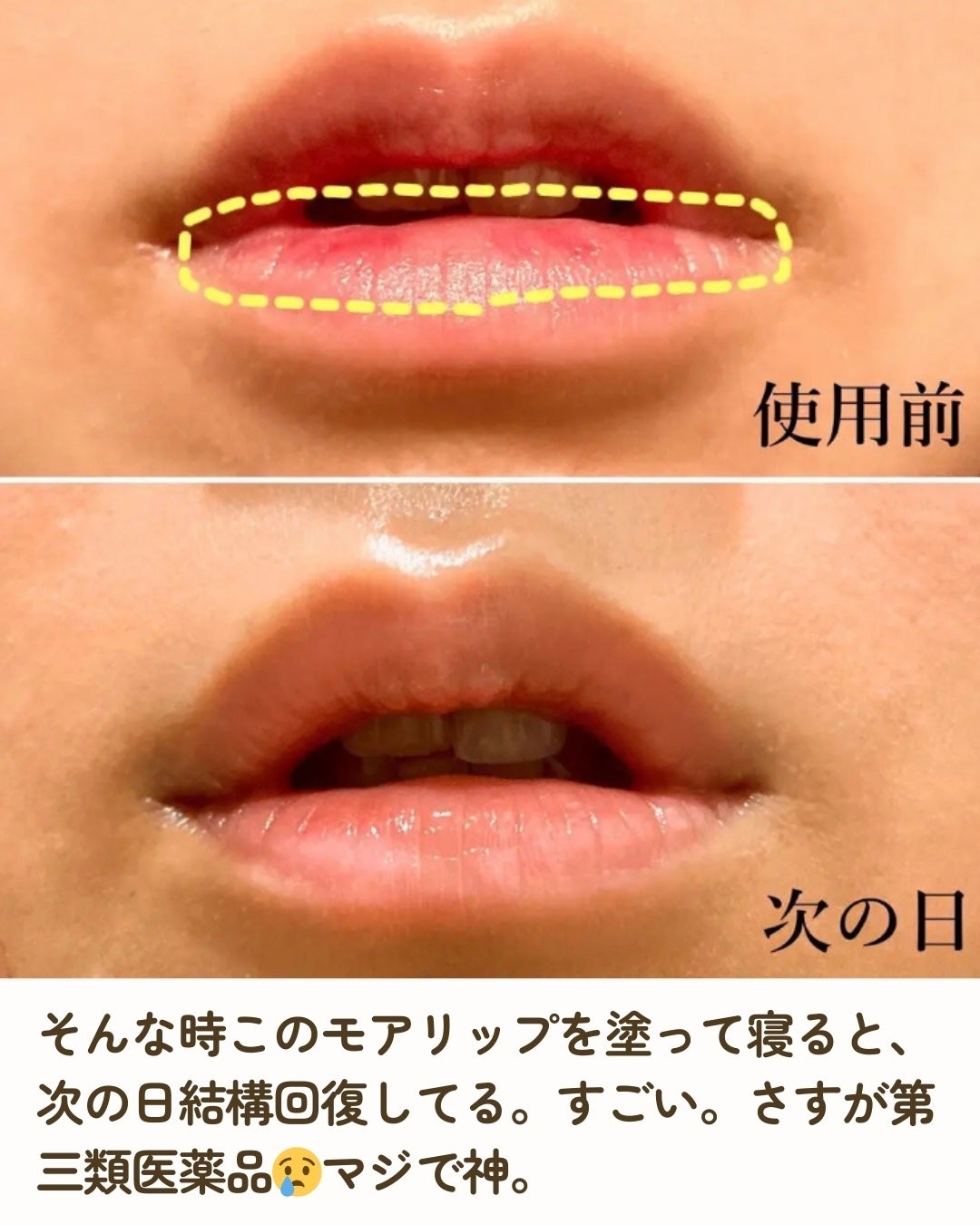 モアリップ N (医薬品)/資生堂薬品/その他を使ったクチコミ(4枚目)