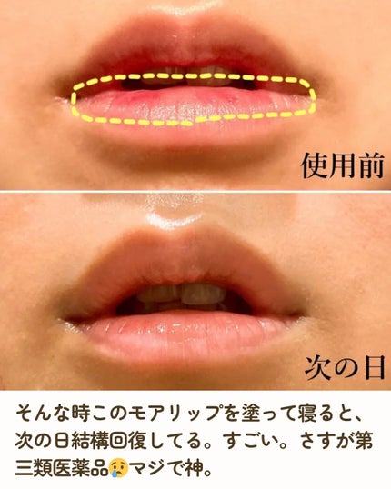 モアリップ N (医薬品)/資生堂薬品/その他を使ったクチコミ(4枚目)