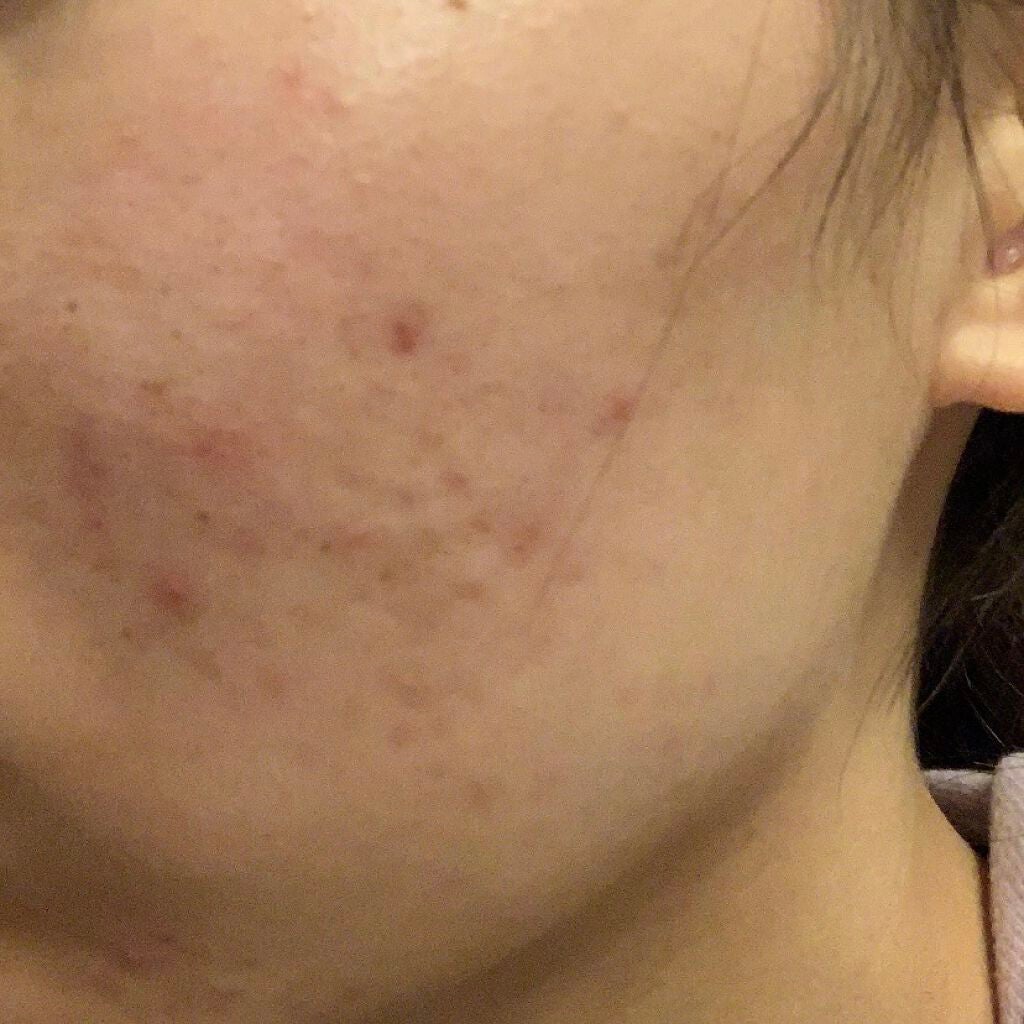 経過観察するよ on LIPS 「ニキビ日記つけます🥲中学生からぽつぽつとできてるニキビが、20..」(2枚目)