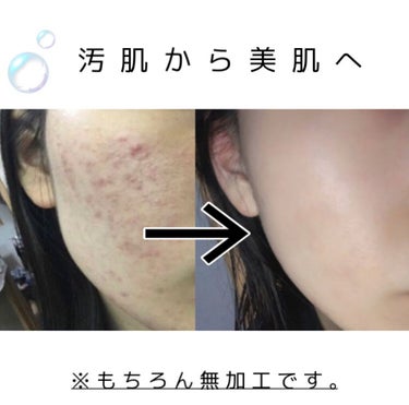 白潤プレミアム薬用浸透美白化粧水/肌ラボ/化粧水を使ったクチコミ（1枚目）