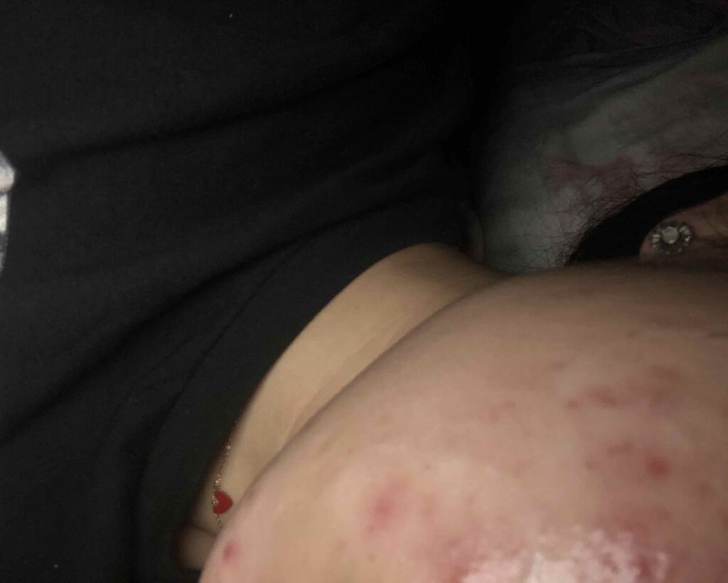 エピデュオゲル/マルホ株式会社/その他を使ったクチコミ（2枚目）