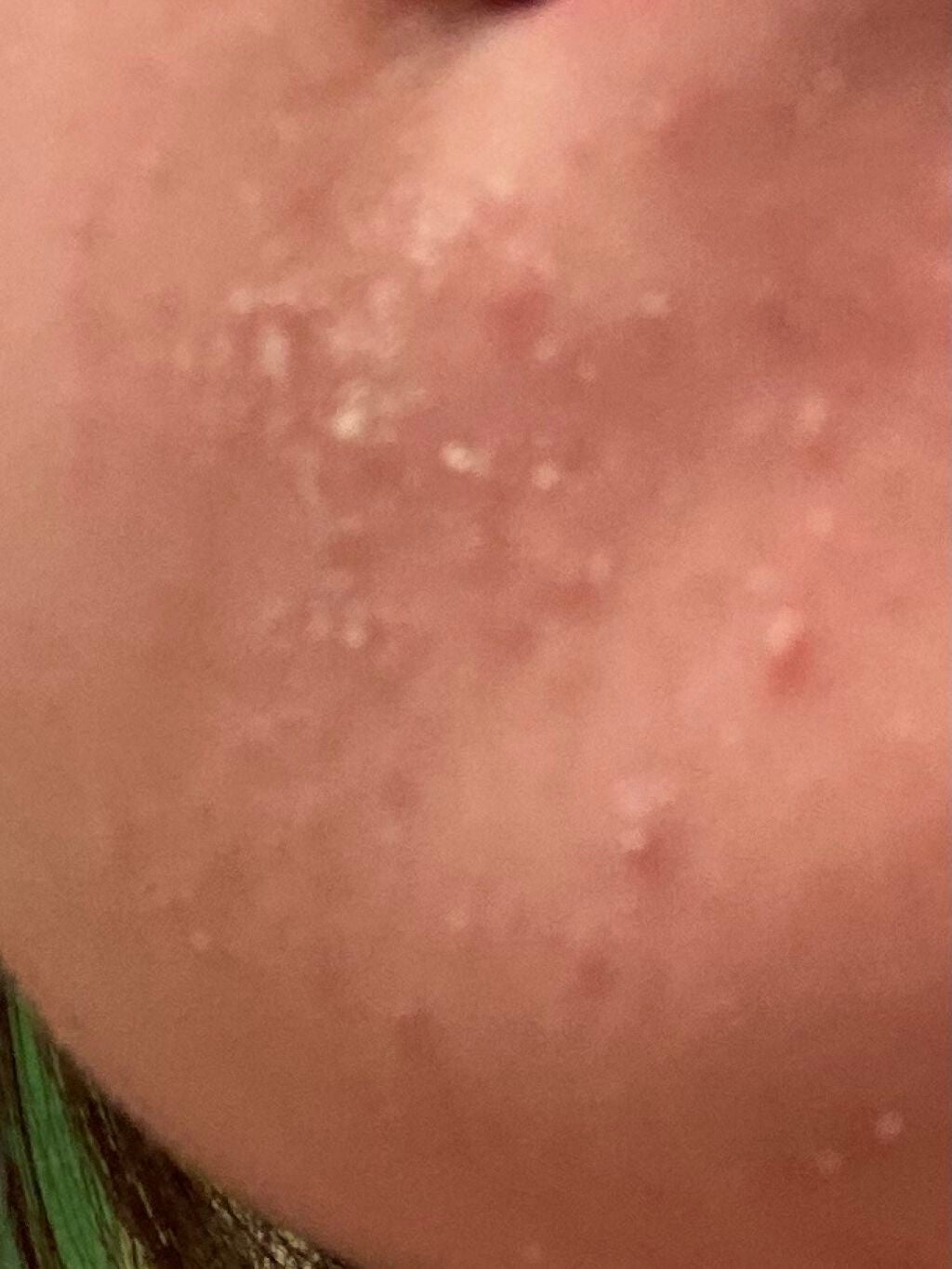 aya on LIPS 「4枚目閲覧注意です💦お久しぶりです!あやです!べピオゲル使い始..」(5枚目)