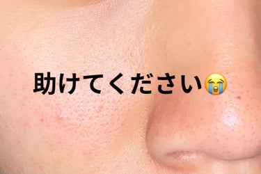 aaa on LIPS 「助けてください😭ニキビは減ってきたのですが毛穴が鼻から頬にかけ..」（1枚目）