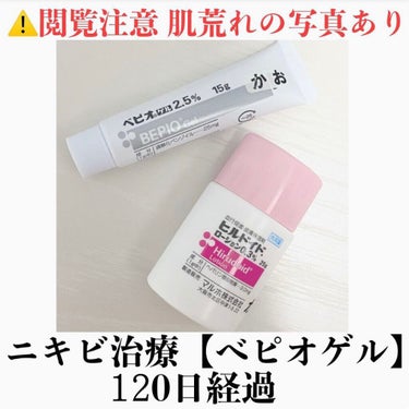 【べピオゲル使用40日~120日経過観察】

ニキビ治療として、べピオゲルの他に、レーザー光を照射する治療を月に一度(計2回)行いました。

✅毎日のスキンケア(以前と同様)
朝･･･ 冷水で洗顔→無印