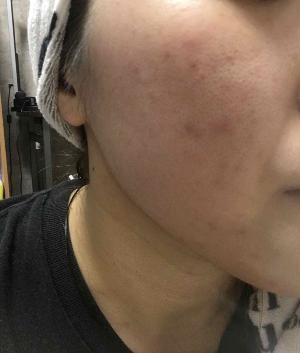 しゃんしゃん on LIPS 「結果的に言うと私的には皮膚科に行くのが一番手っ取り早いです!!..」(3枚目)