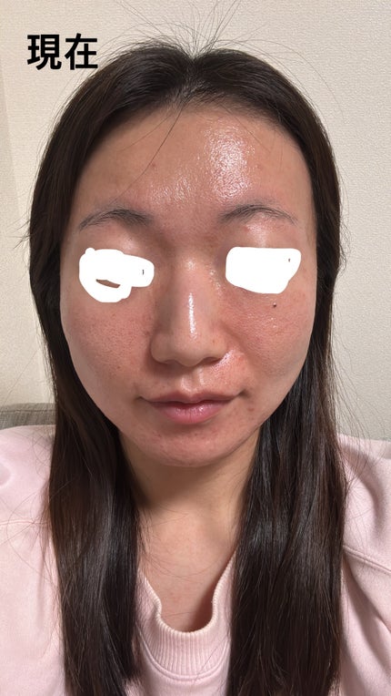 お芋ちゃん|10年以上ニキビに悩む保育士 on LIPS 「中学生のときからニキビが顔全体にあり、学生時代はずっとニキビ肌..」(2枚目)