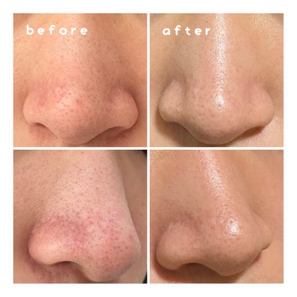 ベピオゲル/マルホ株式会社/その他を使ったクチコミ(2枚目)