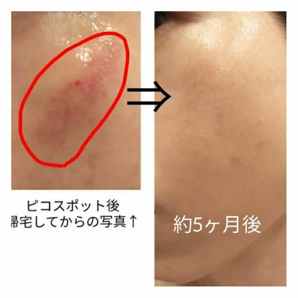 あにゃにゃ♡フォロバ100♡ on LIPS 「5月にしたピコスポット🍅※最後の写真のみ1月した別箇所※今回は..」(6枚目)