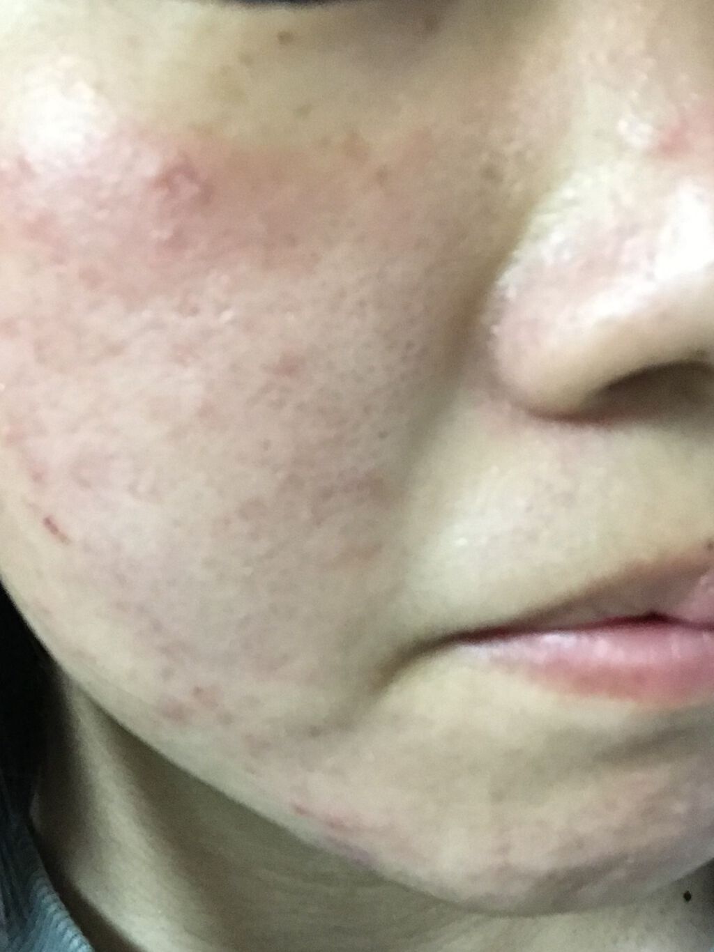 エピデュオゲル/マルホ株式会社/その他を使ったクチコミ（1枚目）