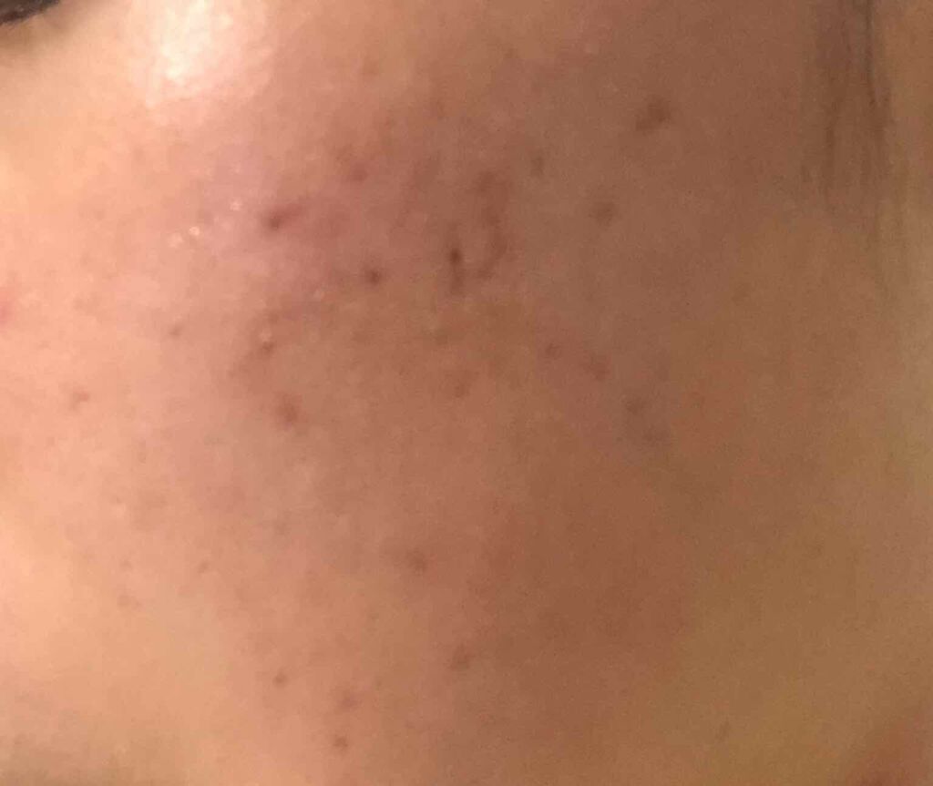 あさひ on LIPS 「5日目とつにゅーいやー、昨日悪化してからどうなったかドキドキし..」(4枚目)