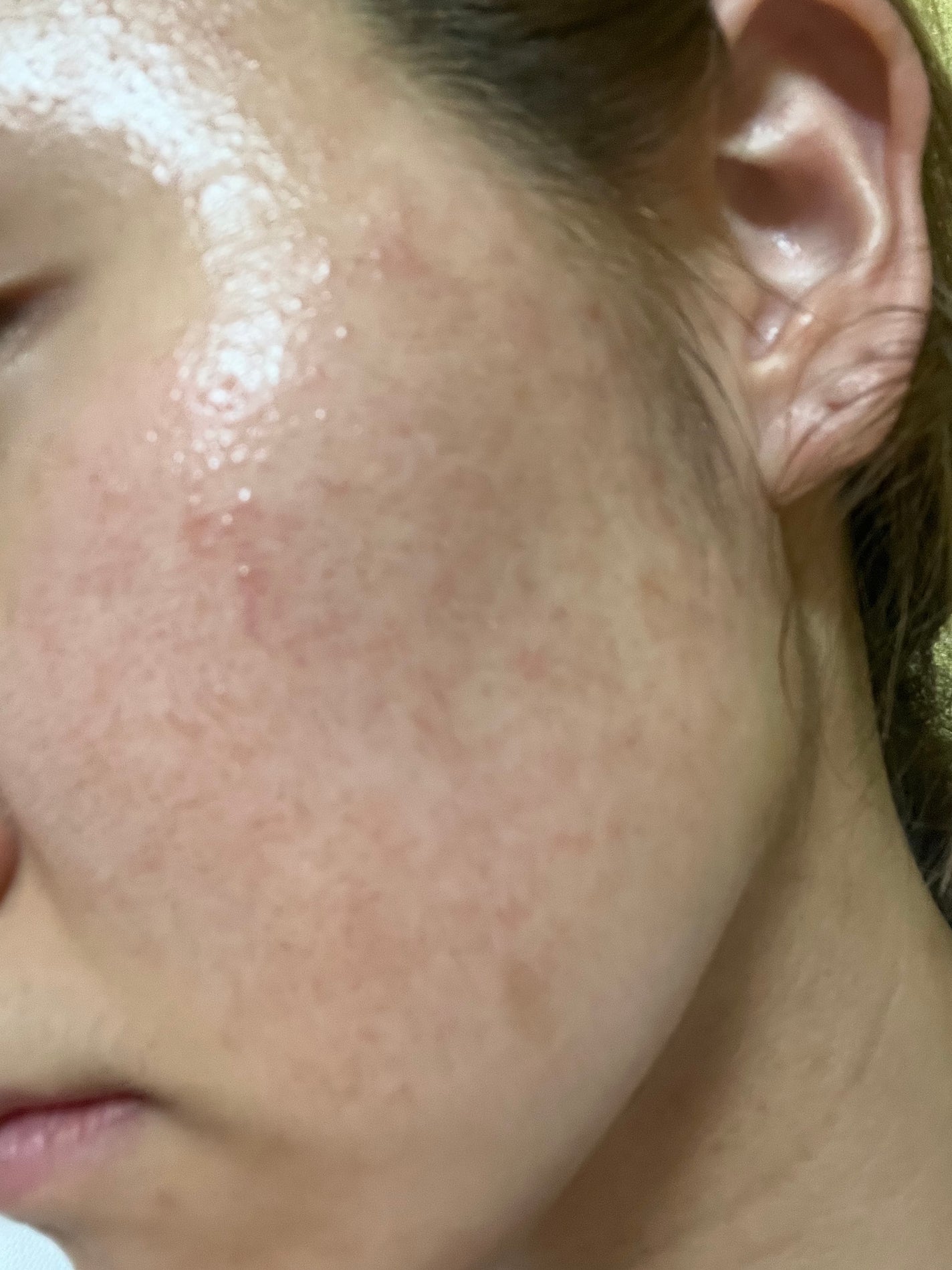 あーちゃん on LIPS 「皮膚科で処方されたアダパレンを塗り始めて1週間☝🏻んーん、..」(3枚目)