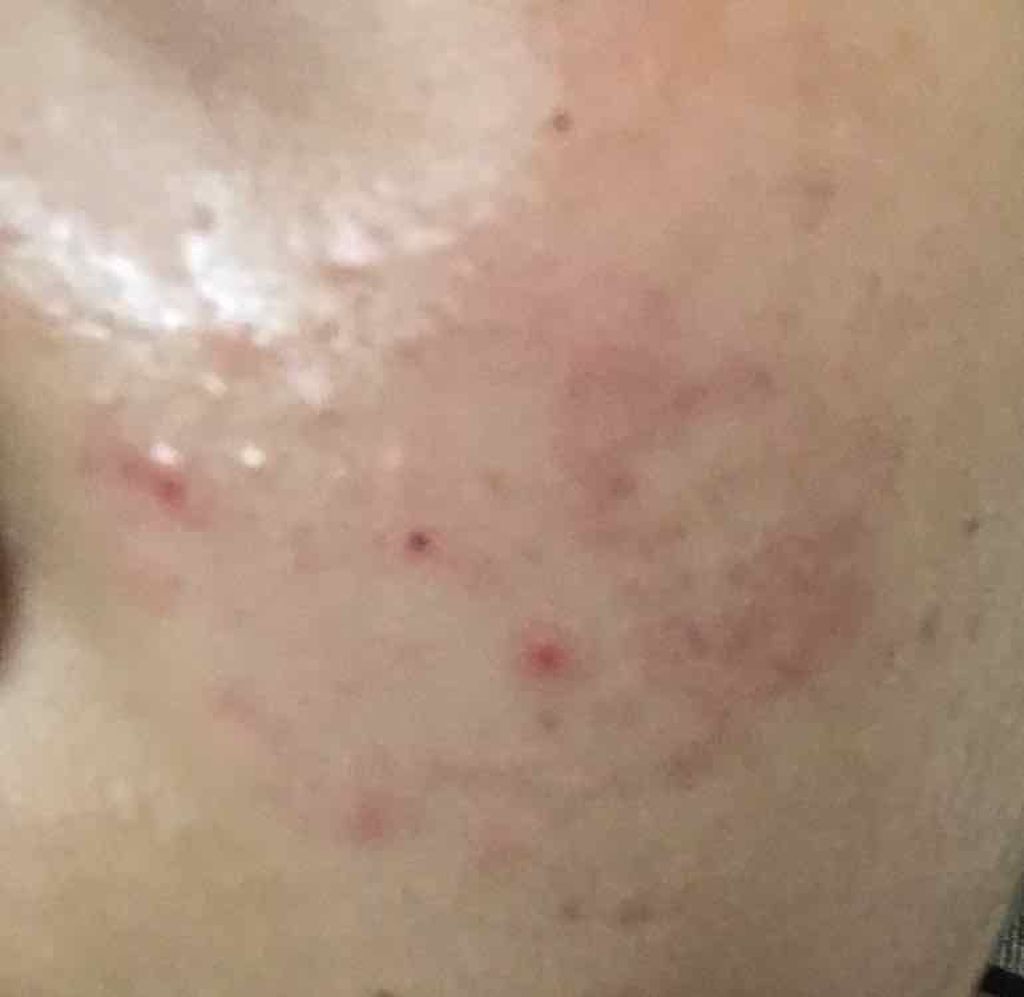 好 on LIPS 「ニキビで困ってる人この指とーーまれ☝🏼私は今とっても思春期ニキ..」(2枚目)