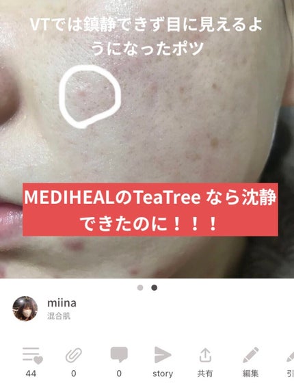 プロCICA クリアスポットパッチ/VT/その他スキンケアを使ったクチコミ(4枚目)