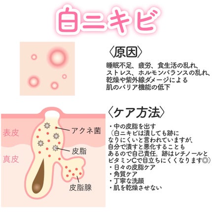パーフェクトホイップ アクネケア/SENKA(専科)/洗顔フォームを使ったクチコミ(2枚目)