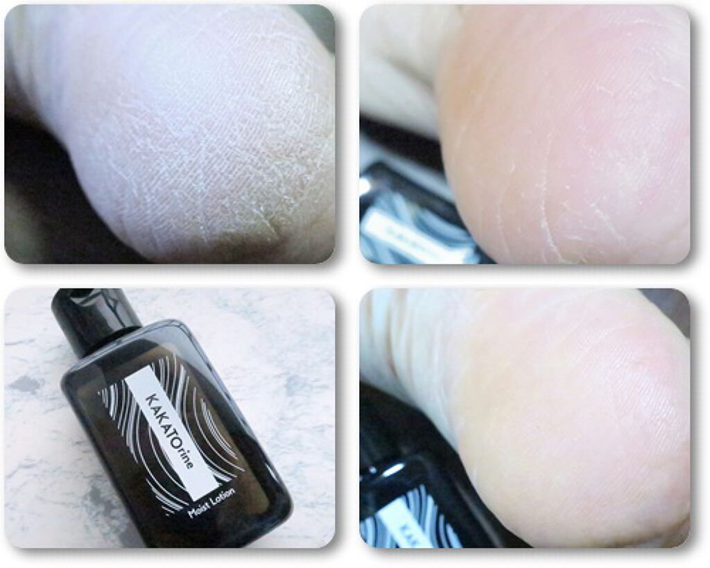 カカトリーヌモイストローション/KAKATOrine/レッグ・フットケアを使ったクチコミ（3枚目）