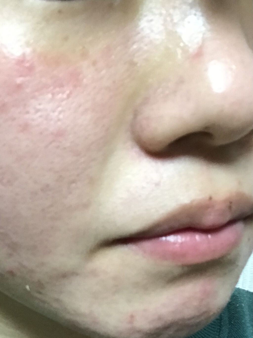 エピデュオゲル/マルホ株式会社/その他を使ったクチコミ（1枚目）