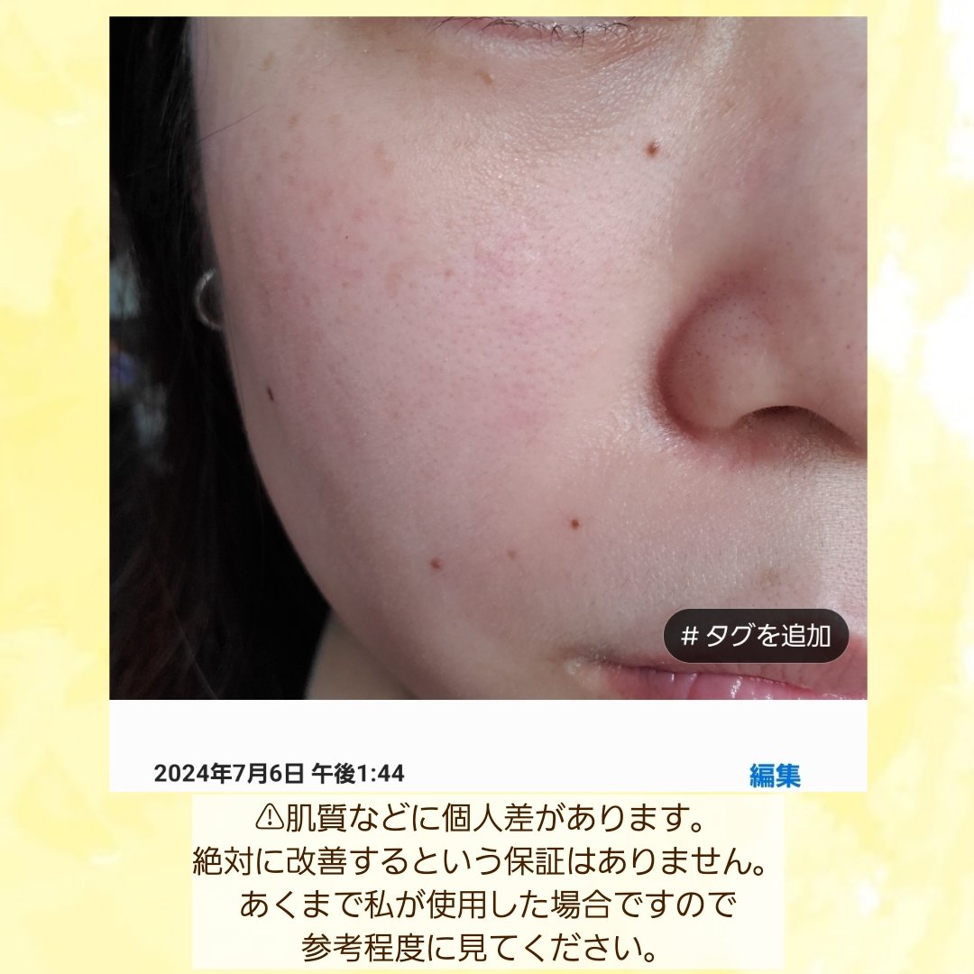 ビタリアルトーニングレーザークリーム/MEDITHERAPY/フェイスクリームを使ったクチコミ（2枚目）