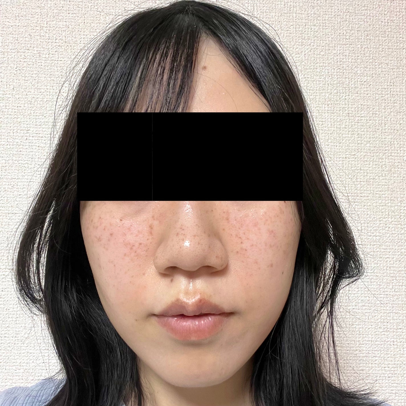 さくらもち餅子 on LIPS 「幼少期からのそばかす治療をしようと思いレーザー治療をしました。..」(3枚目)