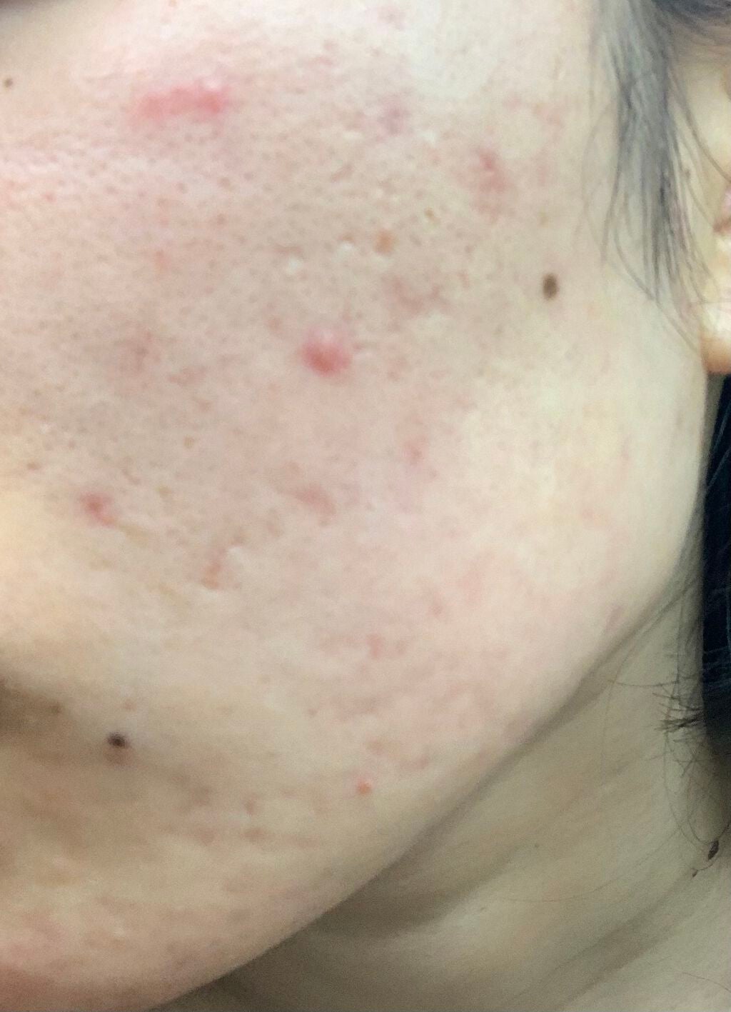 ちい on LIPS 「【私のニキビ日記】⚠️ニキビ肌の写真があります!苦手な方はご注..」(2枚目)