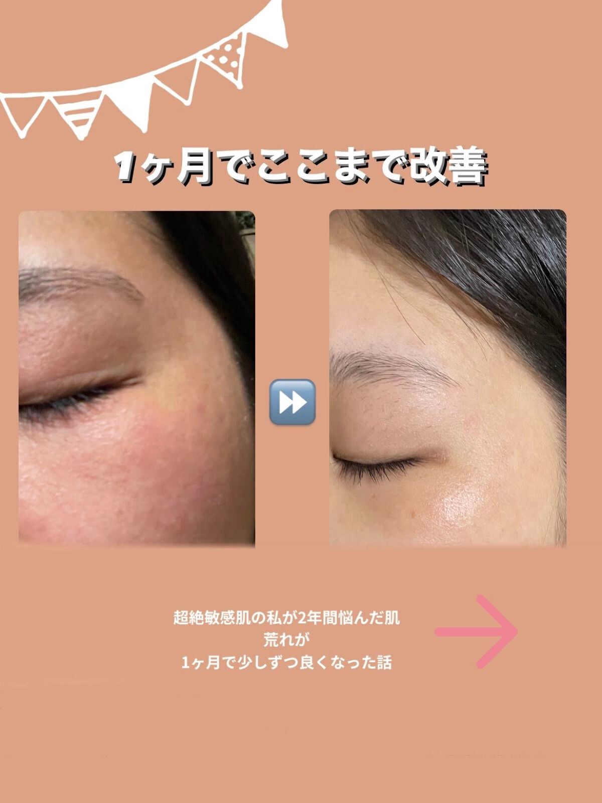 a on LIPS 「超絶敏感肌の私が2年間悩んだ肌荒れが1ヶ月で少しずつ良くなった..」(1枚目)