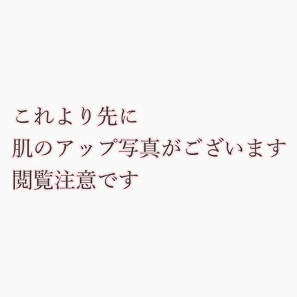 バイオイル/バイオイル/フェイスオイルを使ったクチコミ(2枚目)