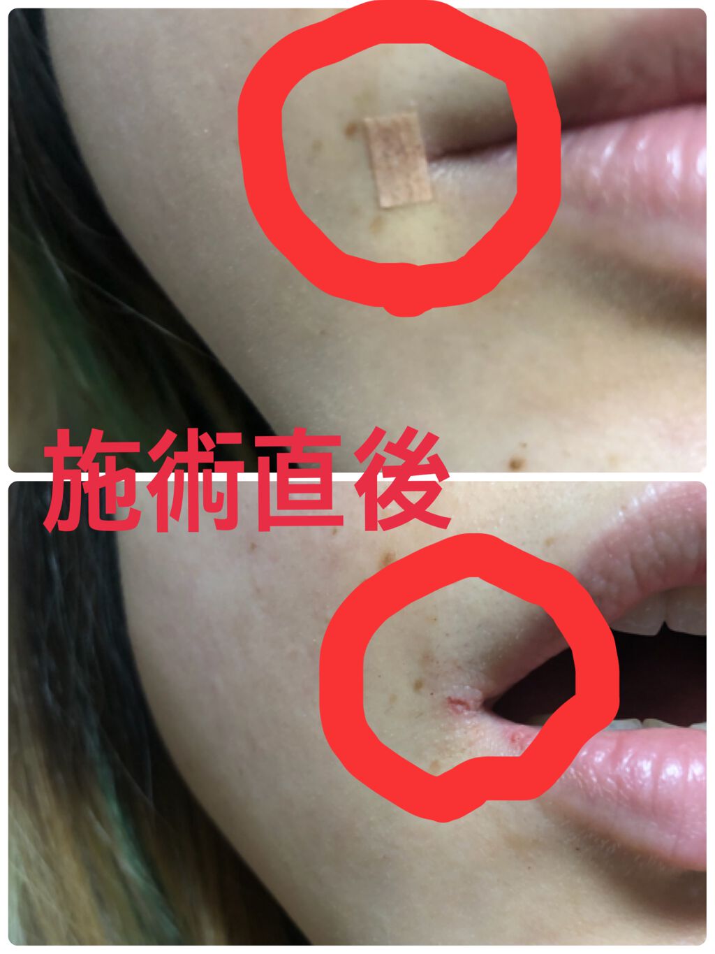 とんとろ on LIPS 「ほくろ、イボ除去の体験談⚠️コスメの話ではありません⚠️今まで..」(3枚目)