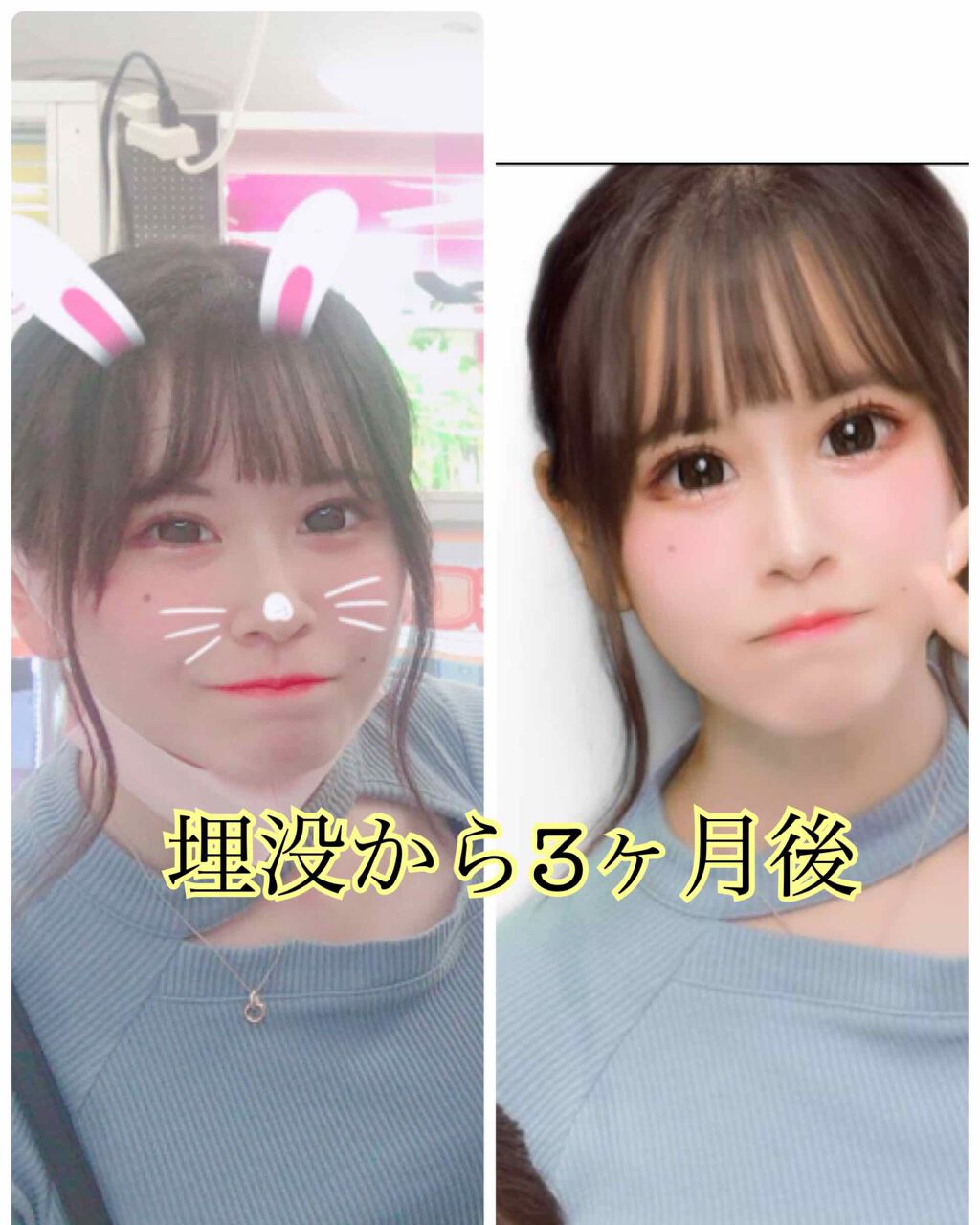 ふ じ り ち ゃ ん on LIPS 「こんばんは💗ふじりちゃんです!少し前の「整形しました」から3ヶ..」(3枚目)