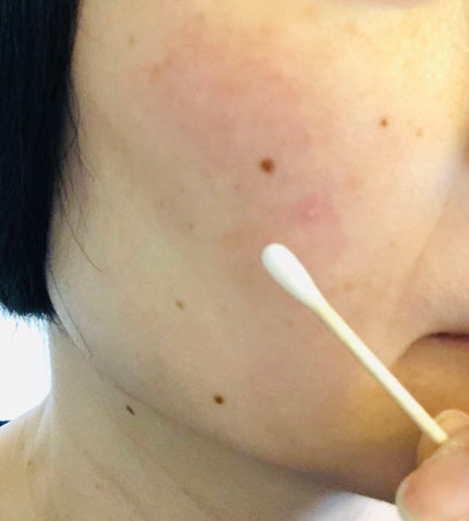 マジックティーツリーオイル/ブラン/フェイスオイルを使ったクチコミ(4枚目)