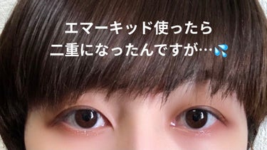 EMAKED

使用二日目です。

一日目使って
「なんかペタペタするなぁ…」と思いつつ放置していたんですが、ずっとペタペタが取れず

ふと鏡を見てみたら…エッ⁈二重になっている、、？(元奥二重)

私