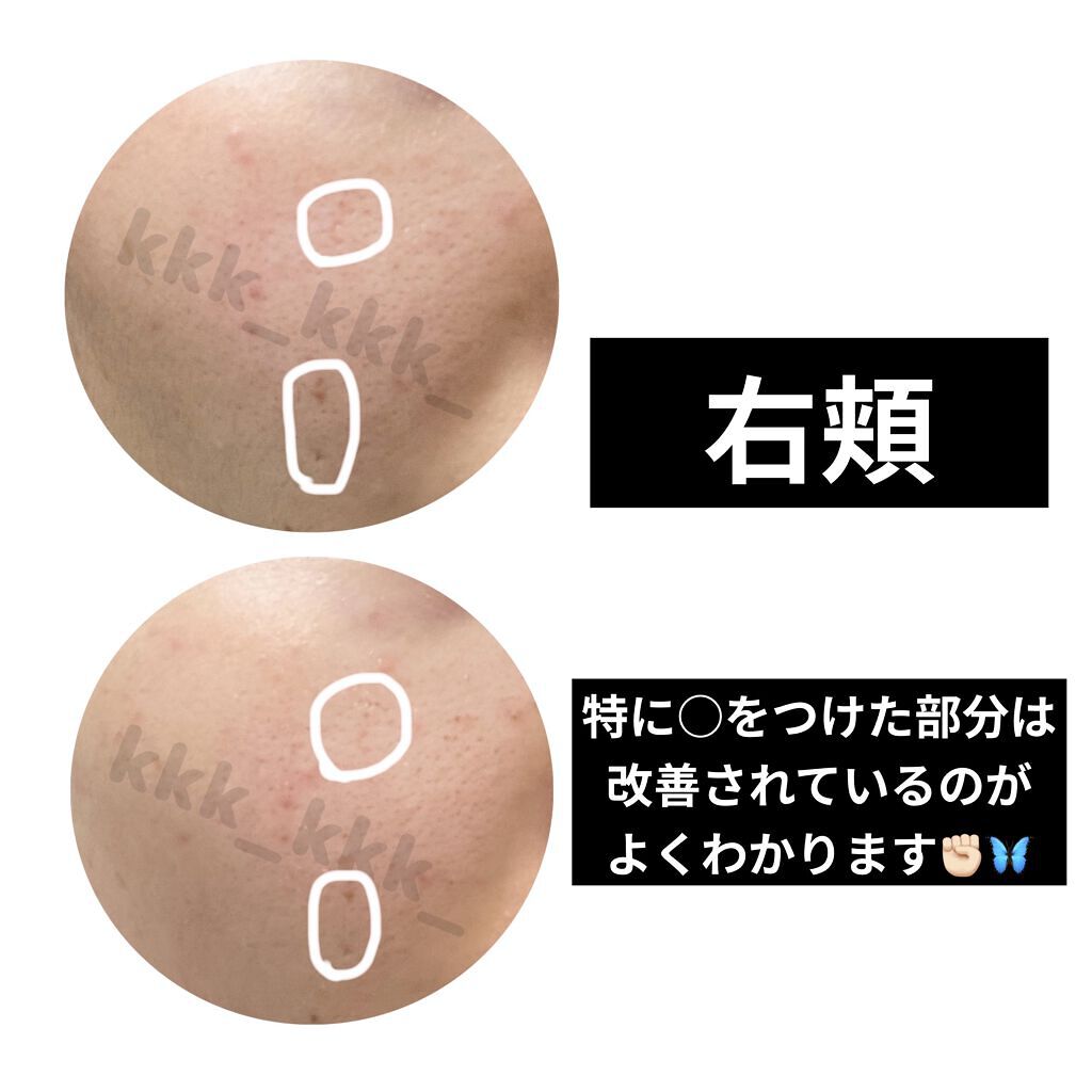 C25セラム ネオ/オバジ/美容液を使ったクチコミ（2枚目）