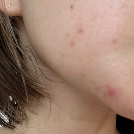 プロCICA クリアスポットパッチ/VT/その他スキンケアを使ったクチコミ(2枚目)