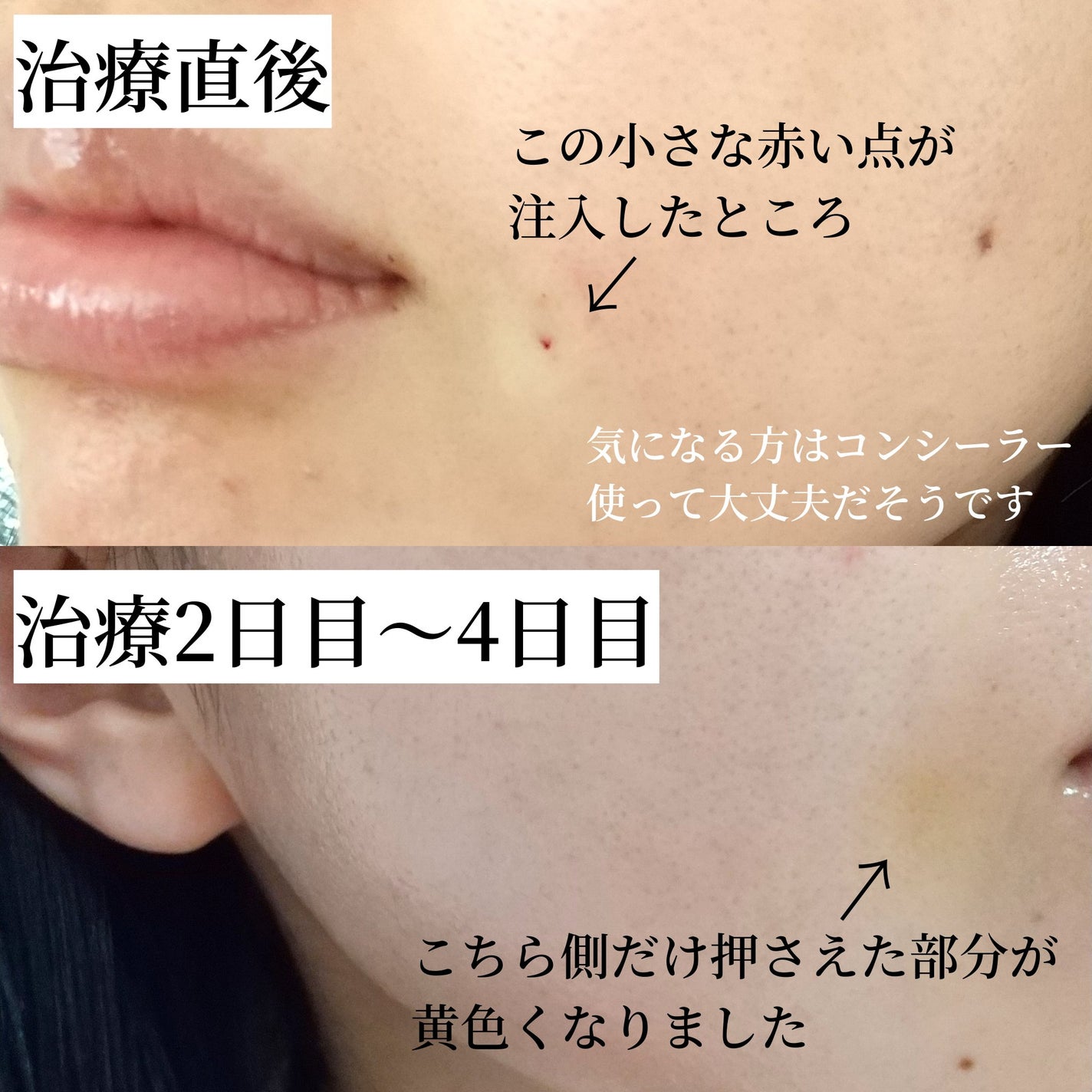 ã¯ãªð«§ on LIPS ããã»ãããç·ãã¢ã«ãã³é
žã¬ããïŒæäžæ¬ã«ã»ãããç·ã«ãã¢ã«ãã³..ãïŒ5æç®ïŒ