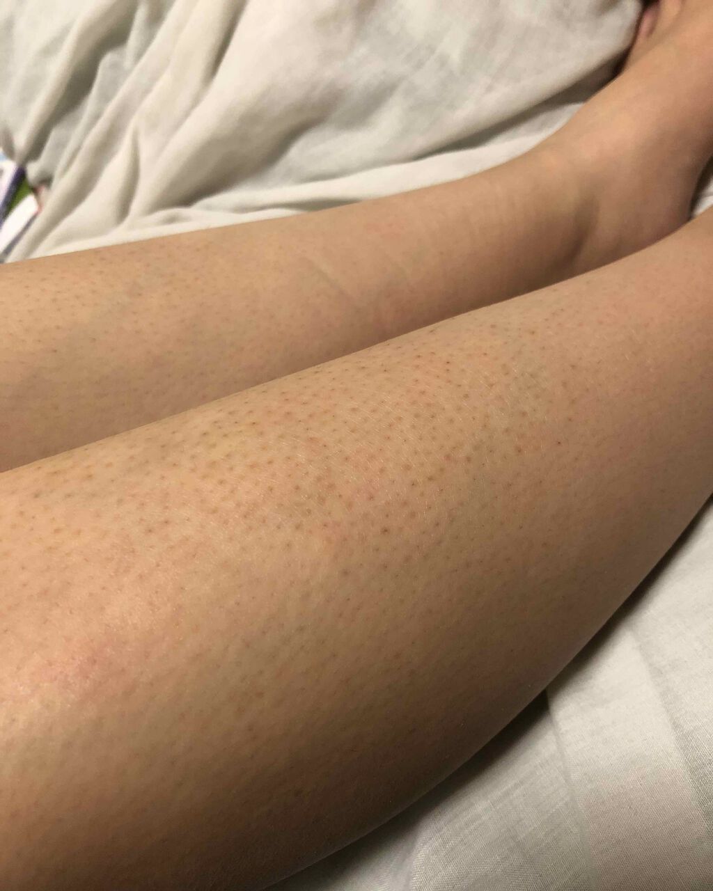 ケアノキュア（医薬品）/小林製薬/その他を使ったクチコミ（1枚目）