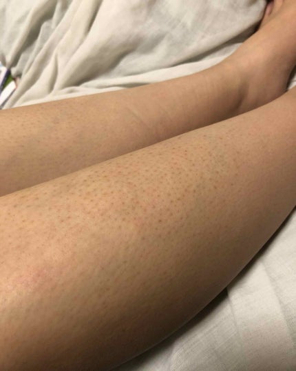 ケアノキュア(医薬品)/小林製薬/その他を使ったクチコミ(1枚目)