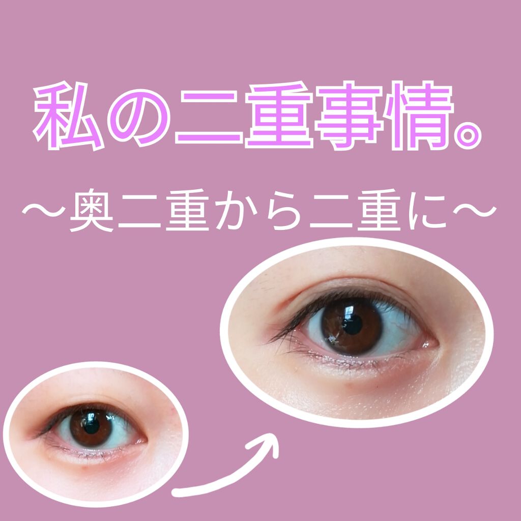 リキッドフィルム ラクオリを使った口コミ 奥二重でも二重幅は広げられる By 明日香 フォロバ100 アトピー肌 代前半 Lips