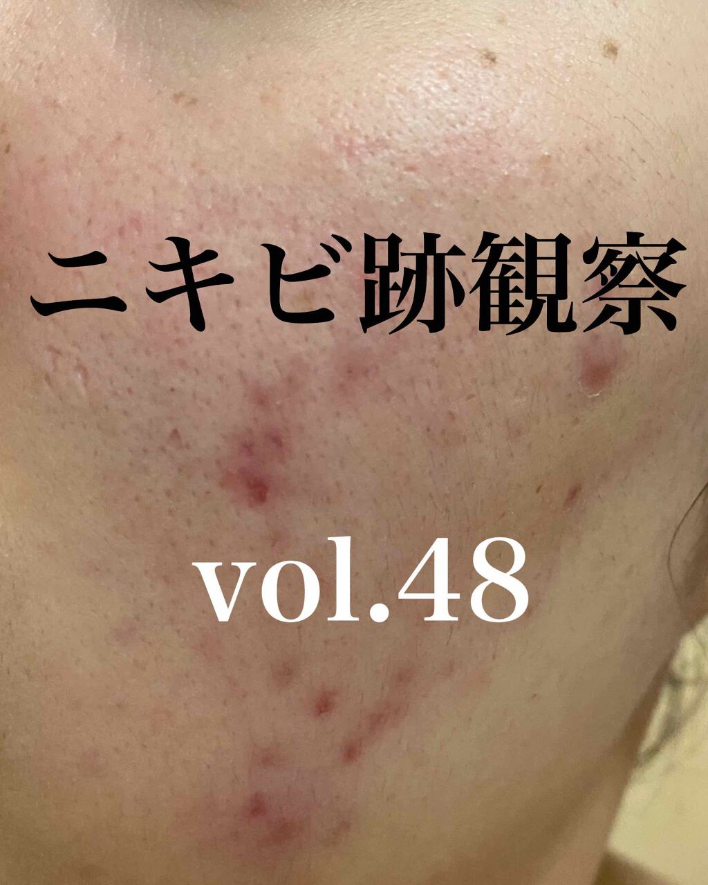 薬用アクネホワイトニング ジェル(部分用美容液)/DHC/美容液を使ったクチコミ(1枚目)