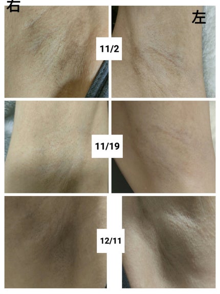 むぎむぎ フォロバ💯 on LIPS 「医療脱毛1回目から1ヶ月ちょい経ちましたので経過レポートです。..」(4枚目)