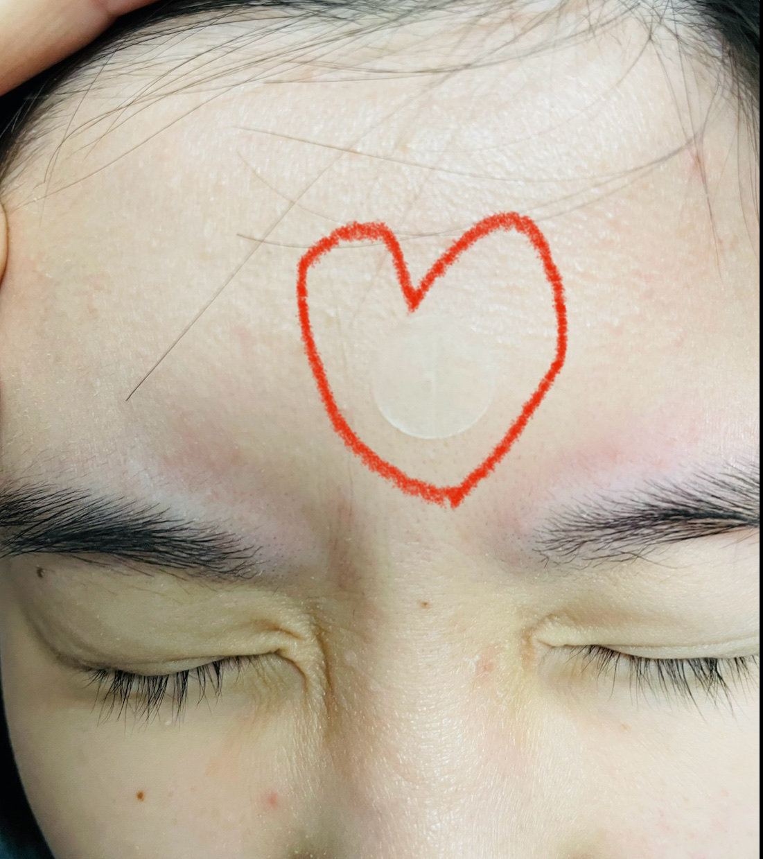 クリアパッチ/Angelab/にきびパッチを使ったクチコミ（3枚目）